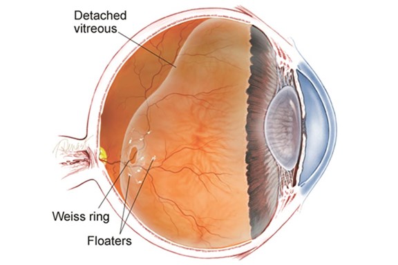 Posterior Vitreous Detachment (PVD)