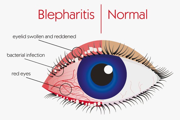Blepharitis