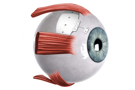 Baerveldt Drainage Implant