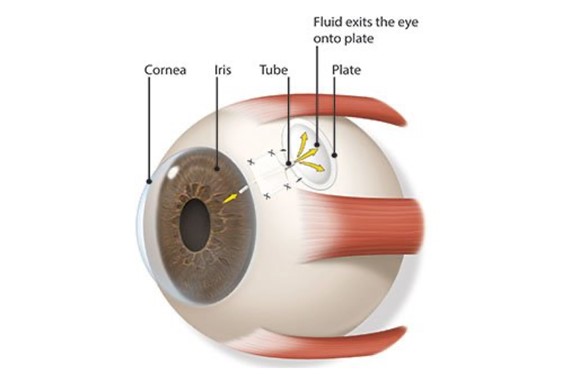 Aqueous Shunt Implants