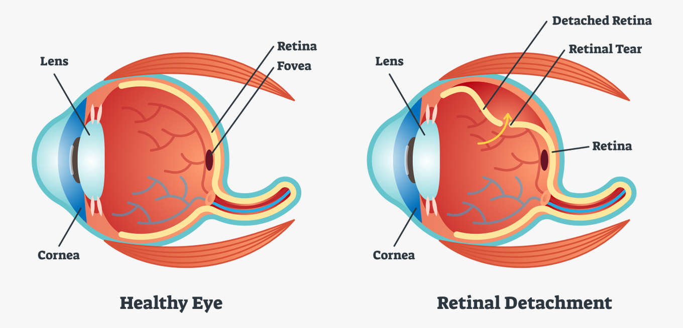 Retinal Detachment (1)