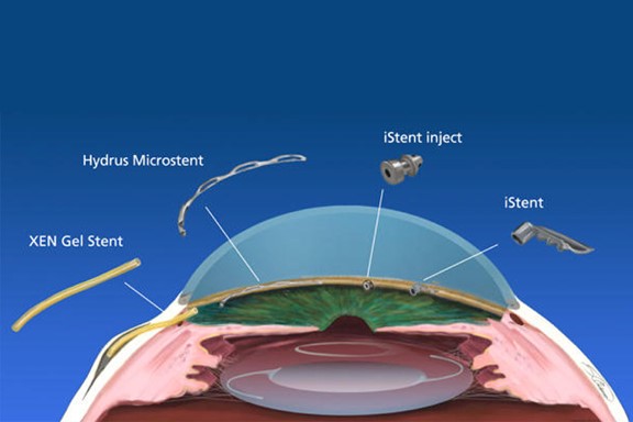 Minimally Invasive Glaucoma Surgery (MIGS)